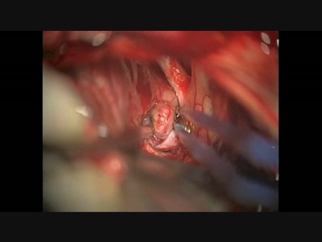 Operacja klipowania tętniaka tętnicy łączącej przedniej mózgu (ACoA)
