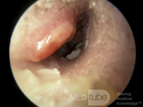 Zapalenie wyrostka sutkowatego drenujące do przewodu słuchowego zewnętrznego (ucho prawe)