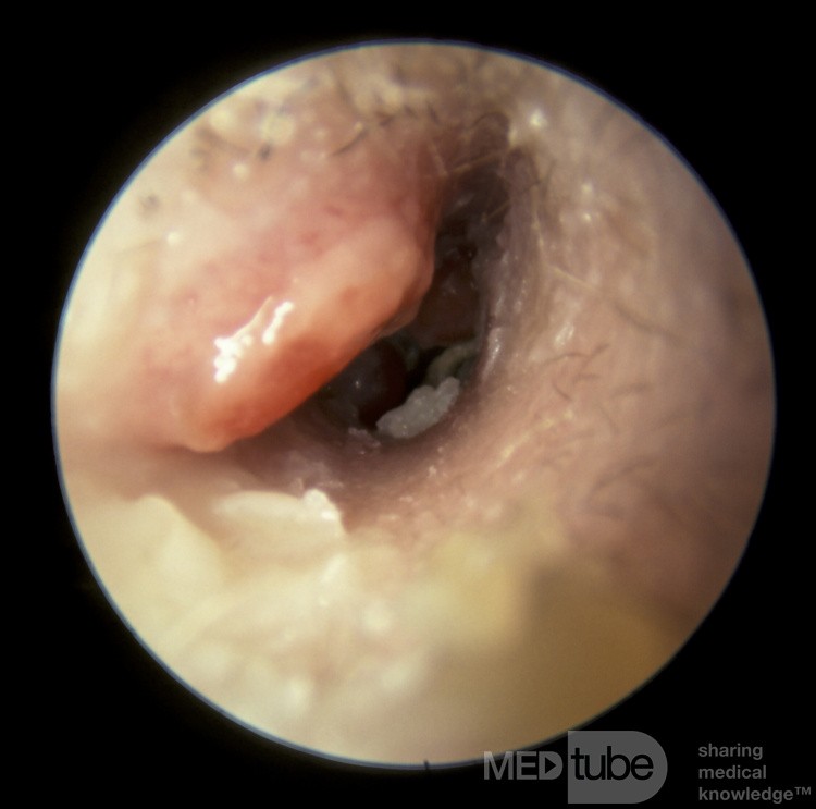 Zapalenie wyrostka sutkowatego drenujące do przewodu słuchowego zewnętrznego (ucho prawe)