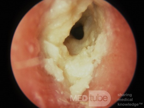 Przewlekłe zapalenie ucha zewnętrznego ze zrogowaciałą keratyną