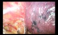 Limfadenktomia okołoaortalna, przednaczyniowa i przytchawicza lewostronna metodą Uniportal VATS (film niepoddany edycji)