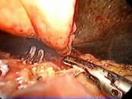 Pankreatoduodenektomia - metoda Whipple'a - część 3/3