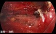Dwuportowa przezpodobojczykowa endoskopowa operacja tarczycy (część 1)