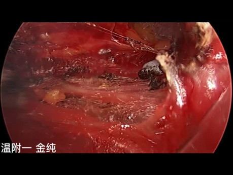 Dwuportowa przezpodobojczykowa endoskopowa operacja tarczycy (część 1)