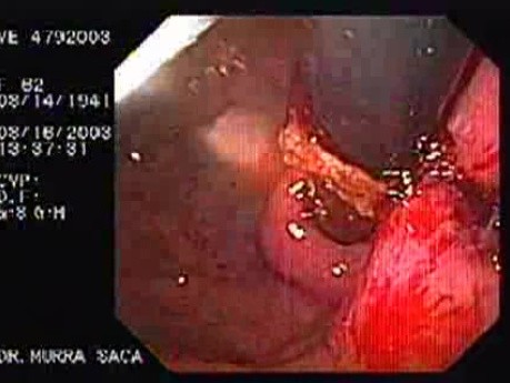 Endoskopowe szycie wewnątrz światła - endoskopowa ocena dna żołądka w finalnym etapie procedury
