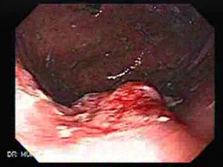 Rak żołądka we wczesnym stadium - endoskopia (2 z 21)