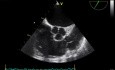 Echokardiografia przezprzełykowa - obserwacja zastawki pnia płuconego