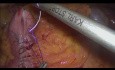 Wewnątrzustrojowa Ileotranswersostomia w laparoskopowej prawej hemikolektomii prawej z testem perfuzji ICG