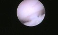 Biopsia de endometrio