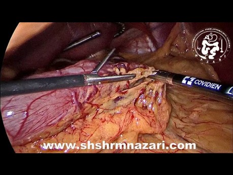 Jednoczesna rękawowa resekcja żołądka i cholecystektomia laparoskopowa