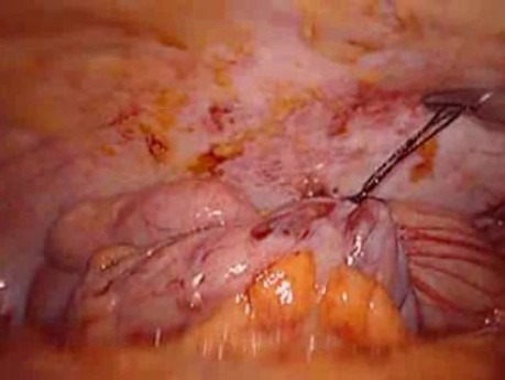 Perforacja okrężnicy z zapaleniem otrzewnej - laparoskopia (21 z 46)