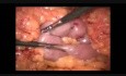 Laparoskopowy zabieg bypassów żołądka