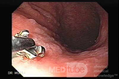 Rak żołądka - metaplazja jelitowa - endoskopia (6 z 7)