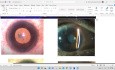 Basic Concepts in Cataract Surgery (Session 2)