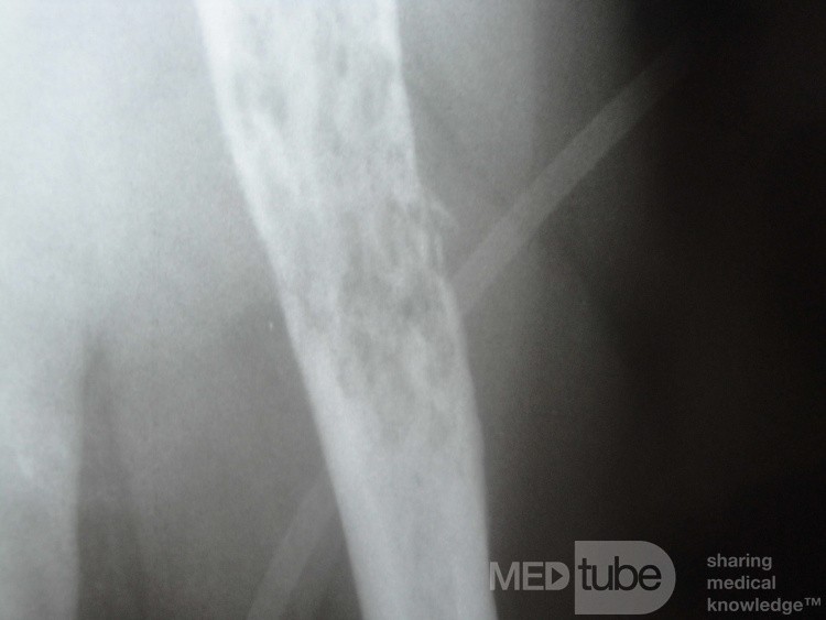 Angiodysplazja w jelicie grubym i szpiczak mnogi (18 z 24)
