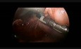 Torakoskopowa resekcja ganglioneuroblastomy u 1-rocznego dziecka