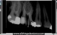  Perforacja Endodontyczna - Pomocne Wskazówki, gdy To - stanie się Tobie