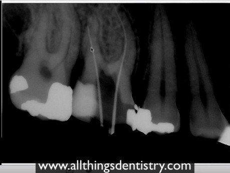  Perforacja Endodontyczna - Pomocne Wskazówki, gdy To - stanie się Tobie
