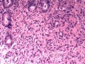 Obraz endoskopowy raka włóknistego żołądka obejmującego dno, trzon i część przedodźwiernikową (5 z 47)
