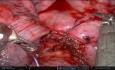Resección robótica uniportal del manguito del bronquio principal izquierdo para el tratamiento de tumores carcinoides