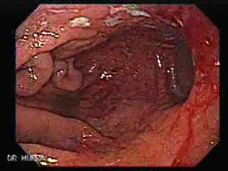 Pierwotny chłoniak żołądka po przeszczepie nerki - bliższe spojrzenie na śluzówkę żołądka