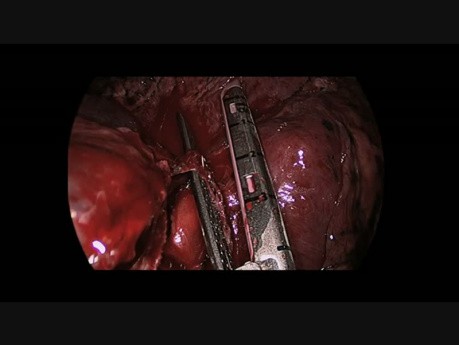 Torakoskopowa lobektomia płata środkowego płuca lewego, przeprowadzona przez jeden port u pacjenta z przełożeniem trzewi.