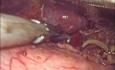 Laparoskopowa operacja zespołu więzadła łukowatego pośrodkowego
