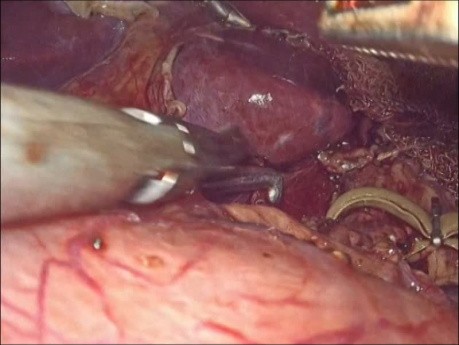 Laparoskopowa operacja zespołu więzadła łukowatego pośrodkowego