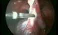 Torbiel jajnika - operacja laparoskopowa