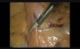 Preparowanie i uwidocznienie tętnicy krezkowej dolnej w laparoskopowych zabiegach chirurgii kolorektalnej w przypadku nowotworu