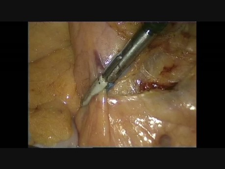 Preparowanie i uwidocznienie tętnicy krezkowej dolnej w laparoskopowych zabiegach chirurgii kolorektalnej w przypadku nowotworu