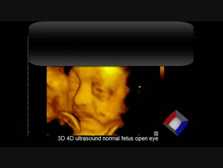 Płód - obrazowanie techniką USG 4D - otwieranie oczu
