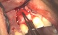 Implantacja z jednoczesną augmentacją. Przypadek pierwszy.