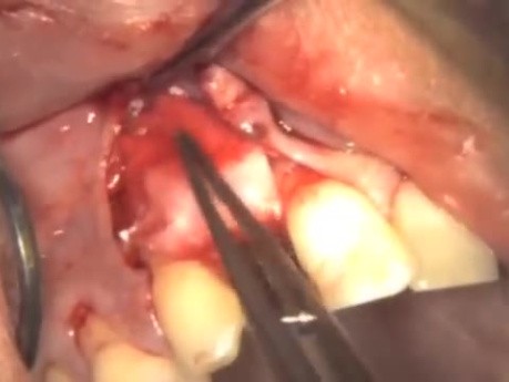 Implantacja z jednoczesną augmentacją. Przypadek pierwszy.