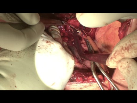 Przeszczep heterogeniczny tętnicy płucnej podczas podwójnej lobektomii rękawowej lewej z powodu niedrobnokomórkowego raka płuca