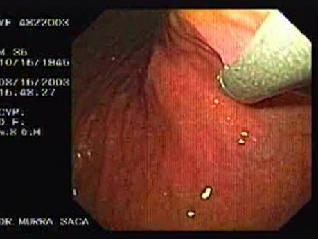 Giętkie urządzenie do szycia endoskopowego, część 2