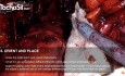 Bilateral extended pelvic lymph node dissection - ePLND
