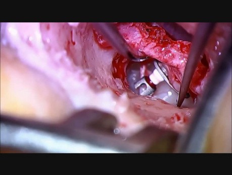 Tympanoplastyka typu zamkniętego - założenie protezki PORP