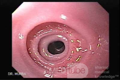 Wrodzone pierścienie przełyku - endoskopowa ocena przełyku, część 1