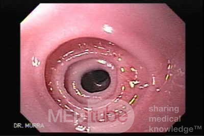 Wrodzone pierścienie przełyku - endoskopowa ocena przełyku, część 1