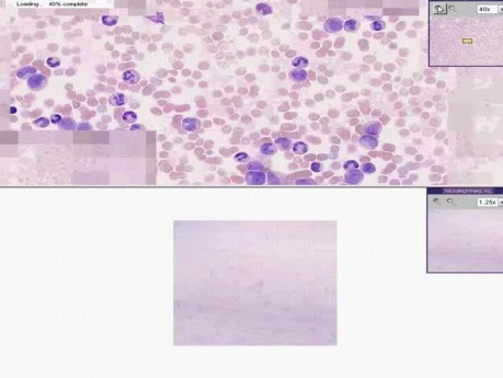 Układ krwiotwórczy - przewlekła białaczka szpikowa
