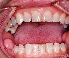 Włóknisto-nabłonkowy polip błony śluzowej jamy ustnej