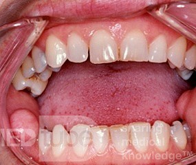 Włóknisto-nabłonkowy polip błony śluzowej jamy ustnej