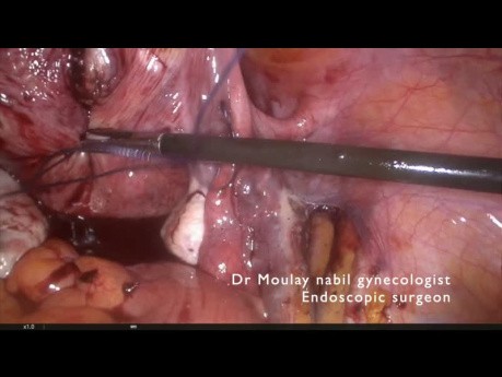 Standardowa miomektomia laparoskopowa
