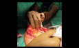 Operacja oszczędzająca pierś  (blokowa mastopeksja) w raku piersi. 