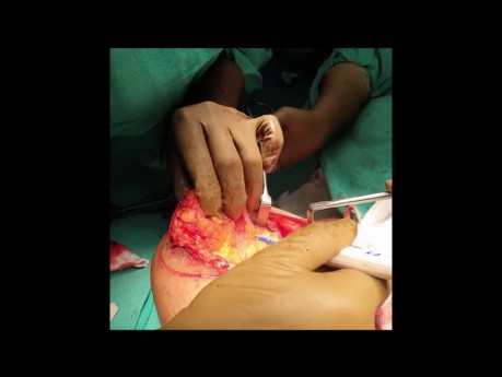 Operacja oszczędzająca pierś  (blokowa mastopeksja) w raku piersi