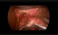 Laparoskopowa kardiomiotomia wg Hellera u 16-letniego pacjetna