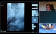Recurrent AAA Reintervention with the Endurant IIs Stent Graft System