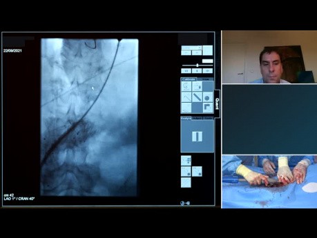 Recurrent AAA Reintervention with the Endurant IIs Stent Graft System