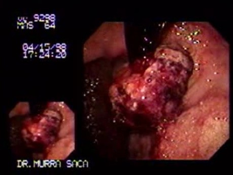 Gruczolakorak dna żołądka - endoskopia